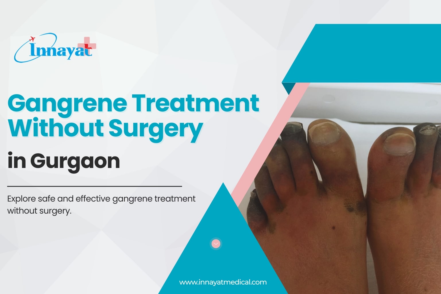 Gangrene Treatment Without Surgery in Gurgaon: A Modern, Limb-Saving Approach