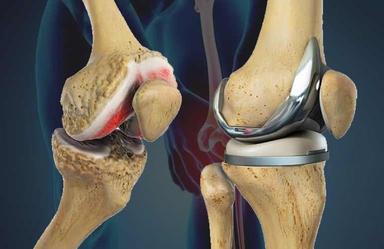 Knee Replacement Cost in India | Full Price Guide